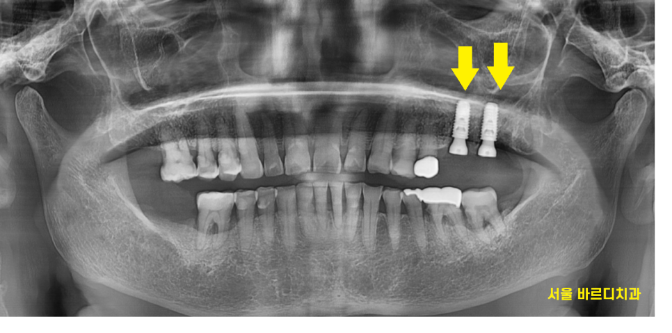 고덕동 치과 임플란트 거부감이 있었지만 네비게이션 수술법으로 해결했습니다. 관련 이미지 10