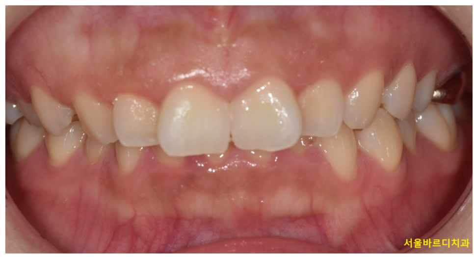 아랫니가 안보여요 과개교합 원인, 문제점 알아보아요! 관련 이미지 1