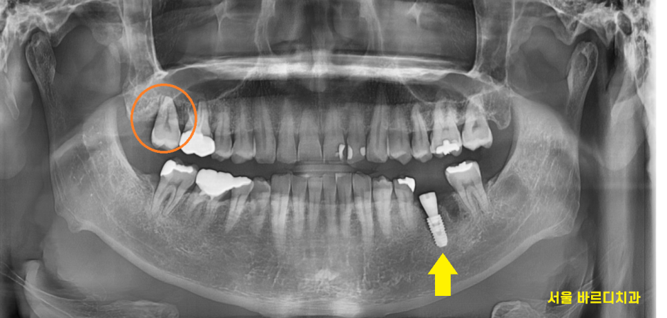 강동구 임플란트 뿌리 염증 심해질경우 대처 방법 관련 이미지 2