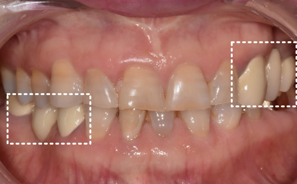 누런 치아 연예인치아 처럼 하얗게 만들 수 있나요? 관련 이미지 7