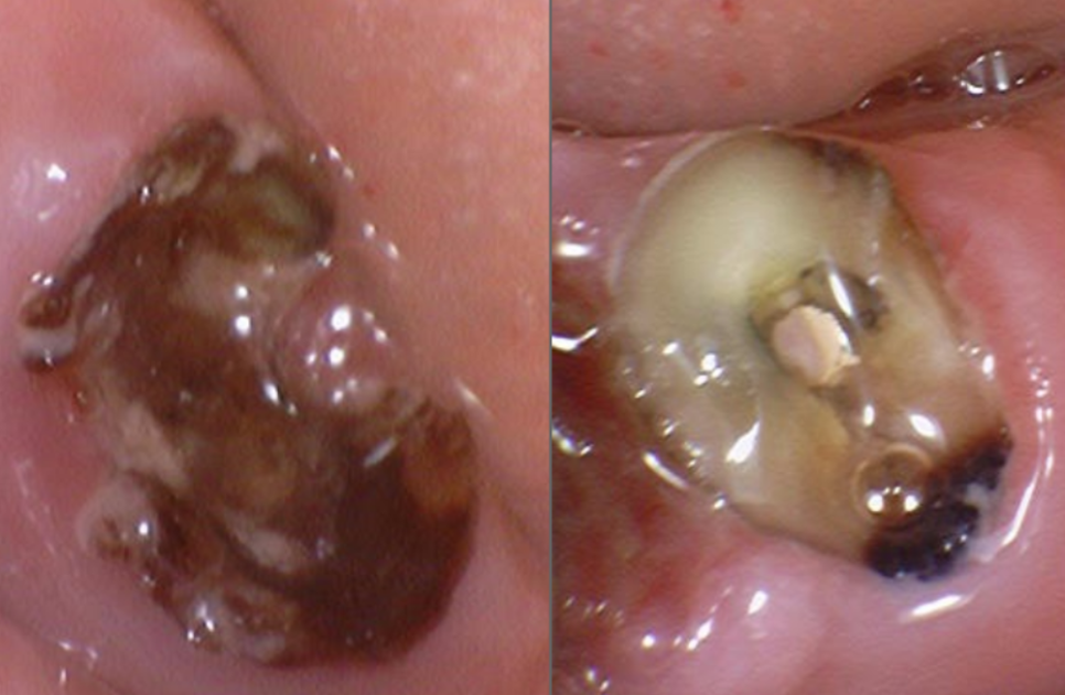 오래된 어금니 롱브릿지, 교체 타이밍을 놓치면 관련 이미지 12