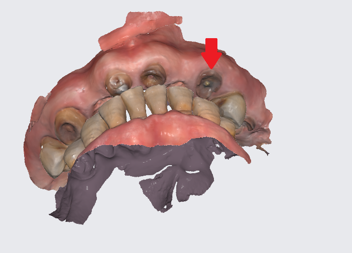 고덕역 치과 위아래 전체 임플란트 디지털을 사용하는 이유? 관련 이미지 5