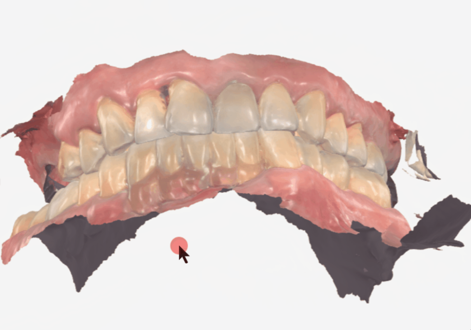 뼈가 없어서 안 된다구요? 70대 당뇨 무치악 환자분의 전체 임플란트 사례 관련 이미지 13