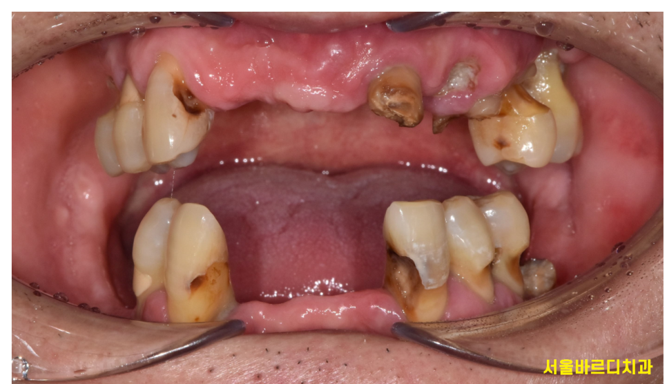 앞니 어금니 임플란트 동시에 진행할때 순서는? 관련 이미지 1