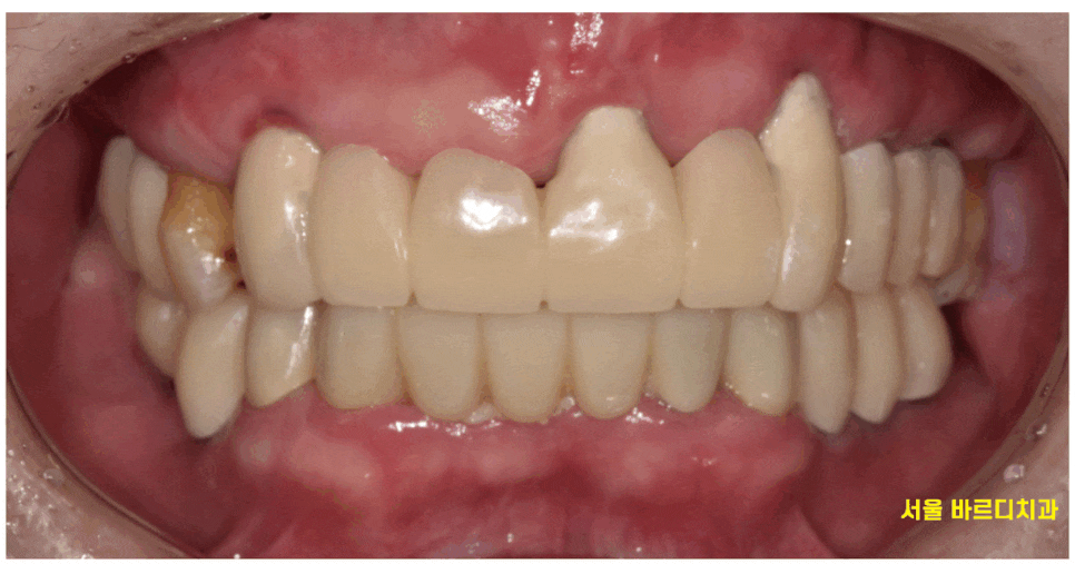 강동구 임플란트 어금니 상실 방치하다 치매까지 옵니다. 관련 이미지 1