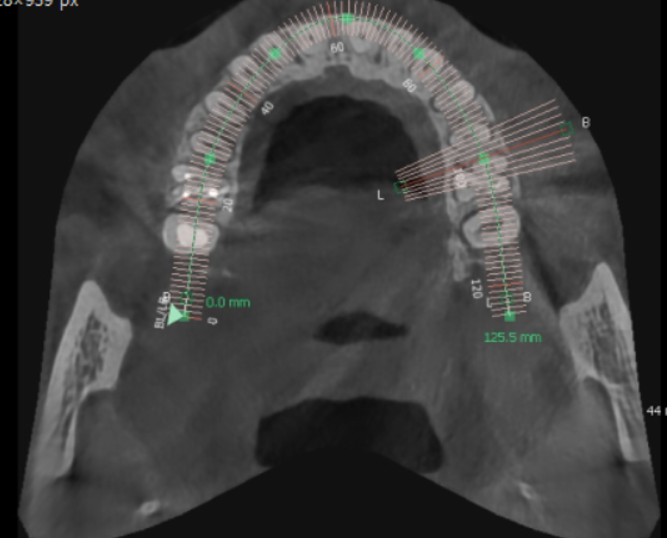 디지털 임플란트 체계적인 수술이 가능한 서울바르디치과입니다. 관련 이미지 5