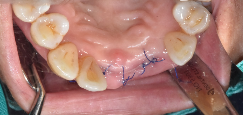 상일동역 치과 윗니 앞니 흔들림 임플란트로 심미까지 잡았습니다. 관련 이미지 10