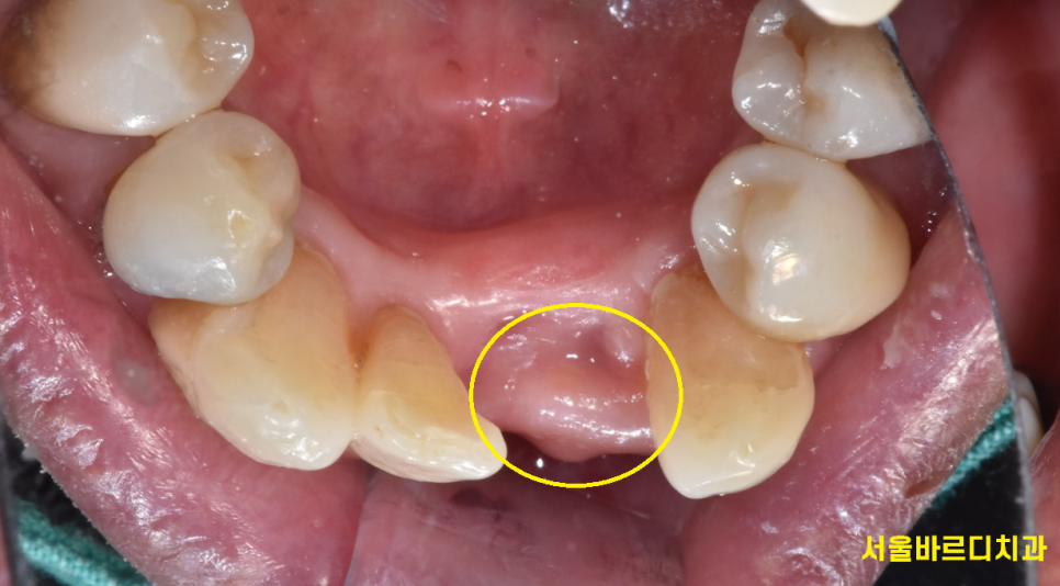 길동 치과 임플란트 수술 대안은 없을까요???? 관련 이미지 7