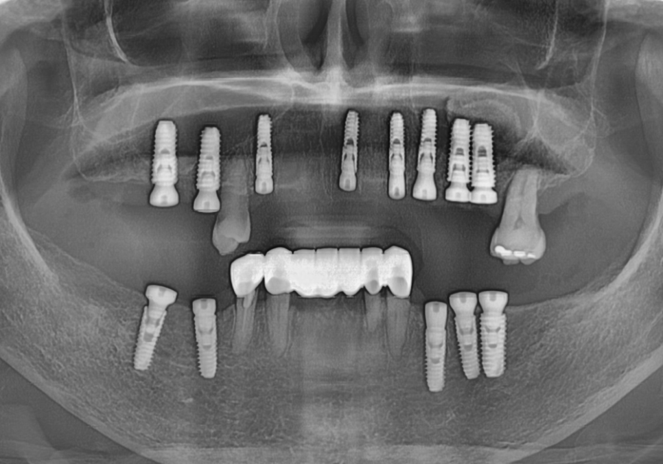 뿌리만 남은 치아, 그대로 두면 왜 위험할까요? 고덕동 전체 임플란트 재건 사례 관련 이미지 15