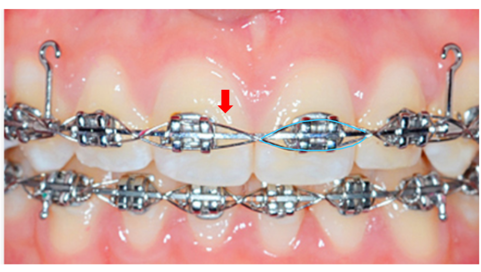 자가결찰 브라켓 빠르게 끝내고 통증은 줄여서 관련 이미지 2