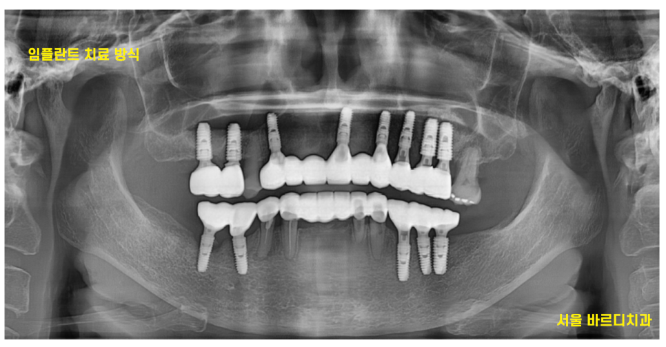 길동 치과 임플란트 틀니 차이 세세하게 대공개 관련 이미지 5