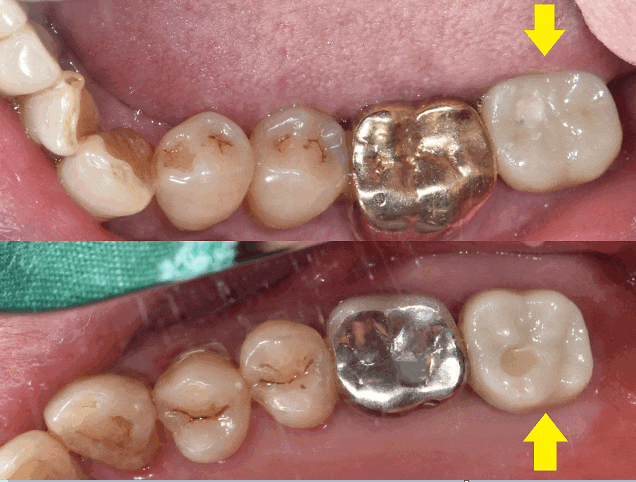 강동구 임플란트 위 아래 어금니 동시 식립으로 치료기간 대폭 축소 관련 이미지 1