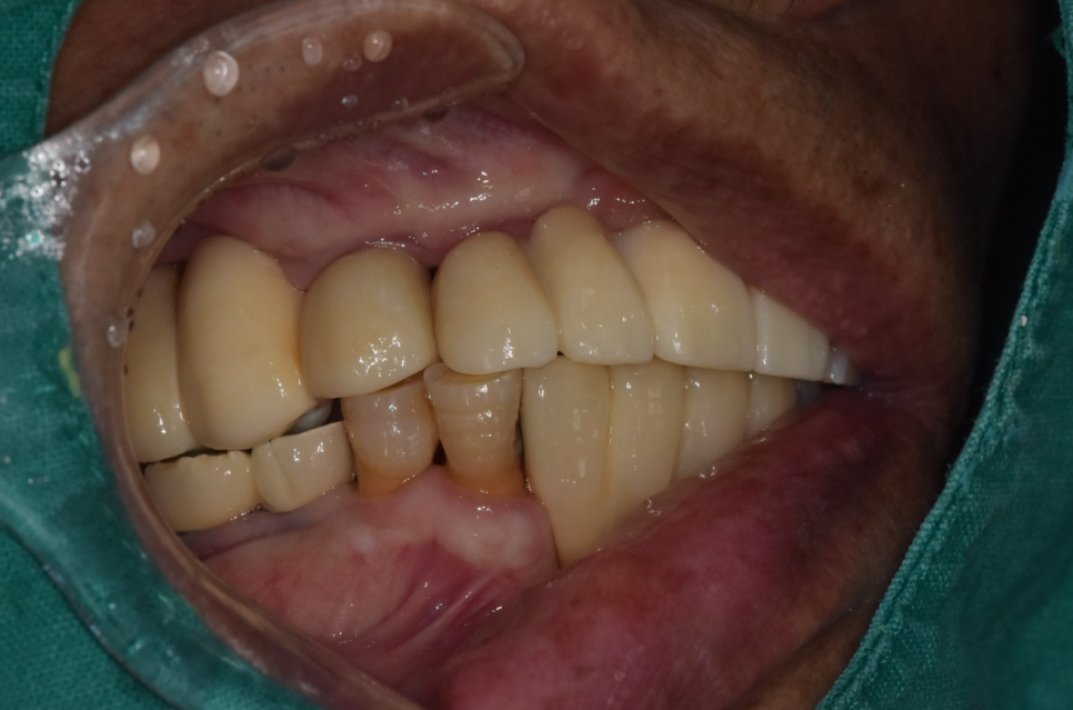 천호동 치과 자연 발치 후 방치된 치아 임플란트 케이스 관련 이미지 12