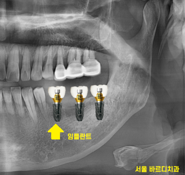 상일동역 치과에서 알려드리는 임플란트 수술과정 대공개 관련 이미지 3