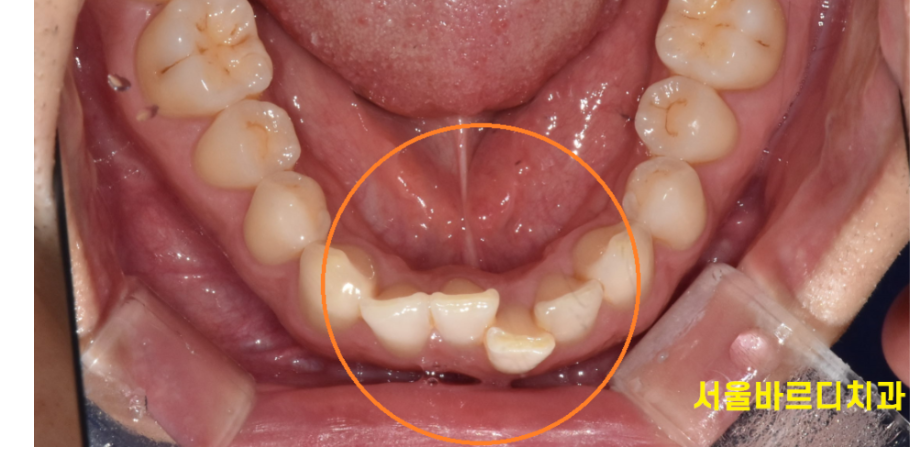 치아 교정 중 사랑니 뽑아야할까?? 관련 이미지 2