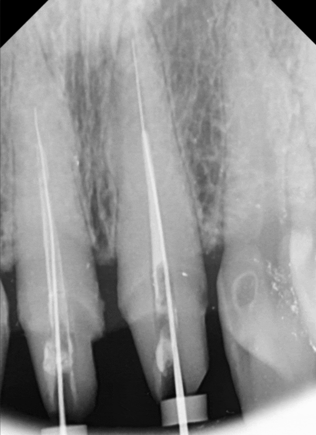 고덕동 심미 보철, 삐뚤어진 앞니, 교정 없이 바로잡은 비결 관련 이미지 6