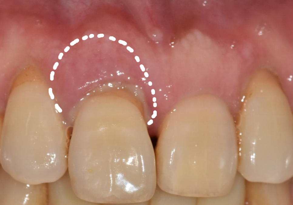앞니 길어짐, 위 앞니가 점점 내려온다면? 관련 이미지 5