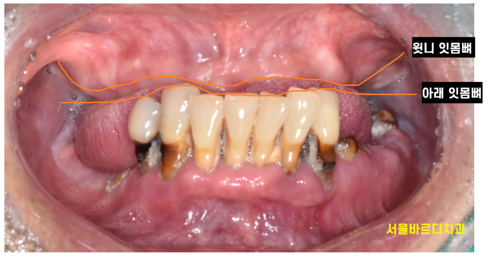 틀니 쓰다가 임플란트 어려움은 ? 높이를 높여주는게 킥!!! 관련 이미지 3