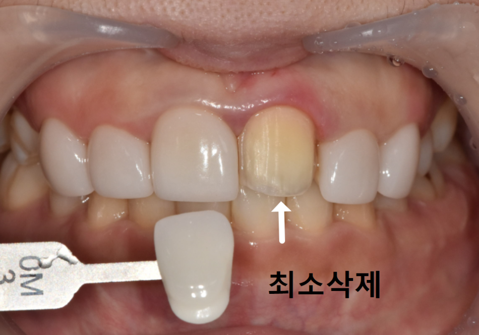 고덕동 무삭제 라미네이트, 실패 없이 하려면 꼭 확인할 3가지 관련 이미지 7