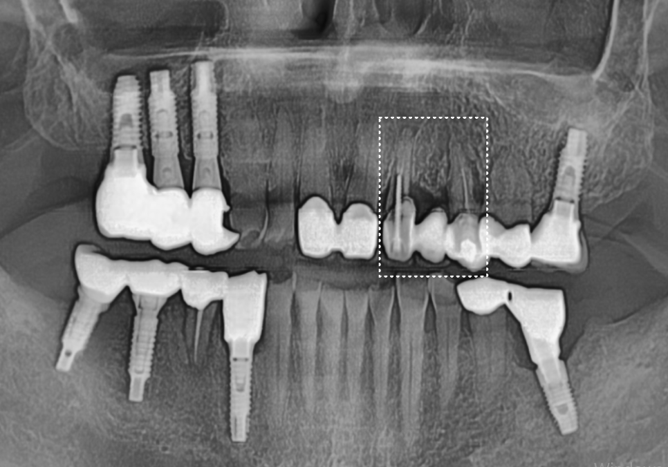 아스피린 복용 중인데 임플란트 수술, 가능할까요? 아스피린 얼마나 끊어야 하나요? 관련 이미지 3