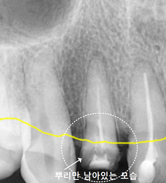 크라운 탈락 빠짐, 빠졌을 때 그대로 다시 붙일 수 있나요? 관련 이미지 8