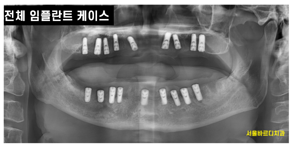 풍산동 임플란트 이 뽑고 임시틀니는 꼭 해야하나요? 플리퍼란? 관련 이미지 6