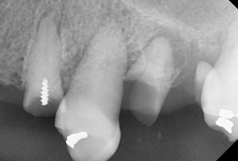 강동구 임플란트 어금니 상실 방치하다 치매까지 옵니다. 관련 이미지 4