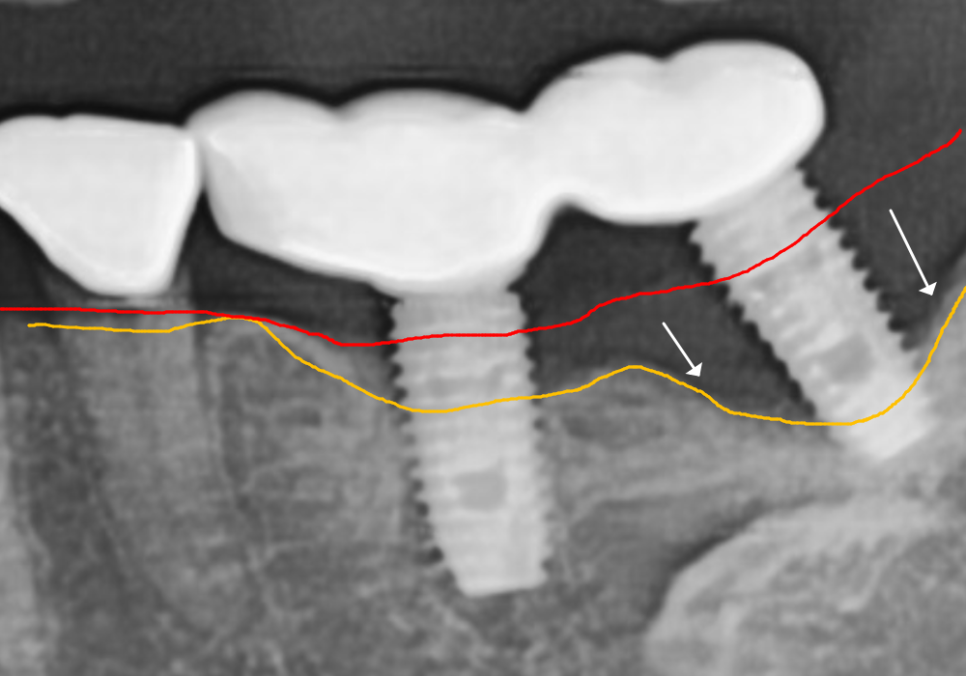 천호동 임플란트 재식립 사례, 평생 쓰는 줄 알았는데? 관련 이미지 7