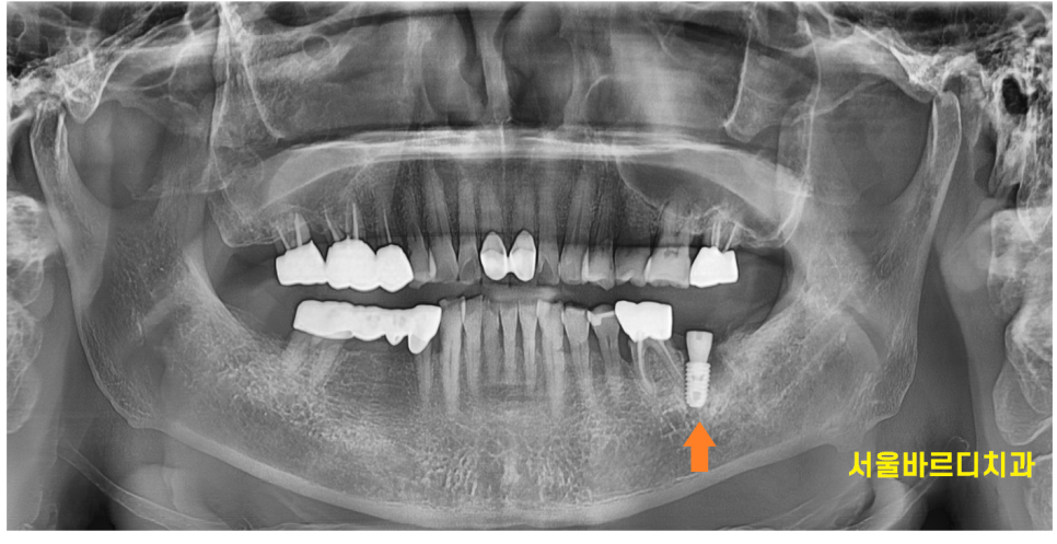천호동 임플란트 치아 뿌리 충치가 파절을 유발하다. 관련 이미지 8