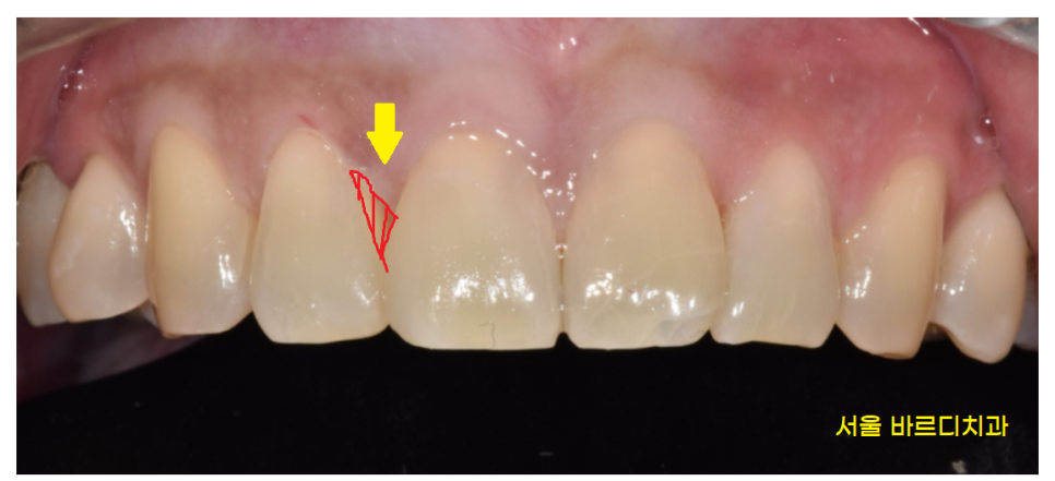 고덕 그라시움 치과 벌어진 앞니 메꾸기 당일 레진으로 치료했습니다. 관련 이미지 6