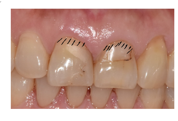 앞니 레진 재치료 변색 부위 연마하면 처음 느낌 그대로 관련 이미지 5