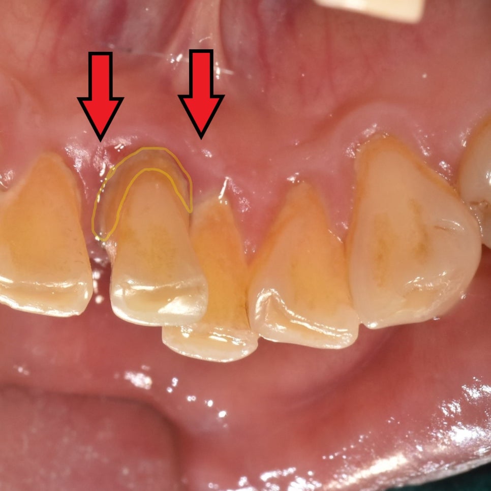 My Teeth Are Shaking So Much That Eating Is Uncomfortable—Is It Okay to Just Leave Them Alone? image 6