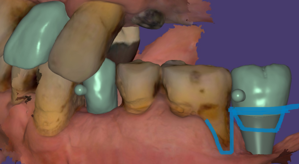 하남시청치과 디지털 임플란트를 고집하는 이유 관련 이미지 14