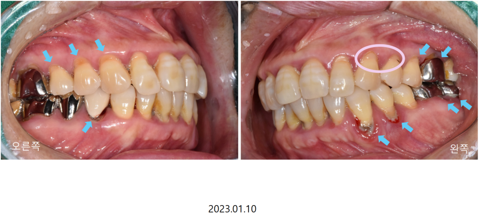 고덕동치과 서울바르디치과 무절개 네비게이션 임플란트 치료증례 #2 관련 이미지 3