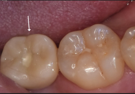 어금니 구멍, 충치 솔직하게 말씀드립니다. 치과 공포증으로 미루신 분들 필독 관련 이미지 16
