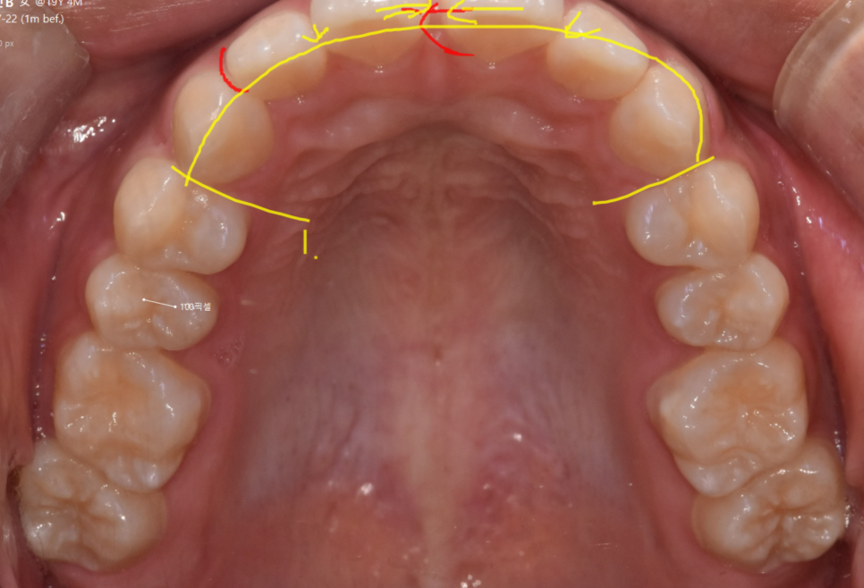 3 Ways to Fix Gaps Between the Front Teeth with Orthodontic Treatment image 5