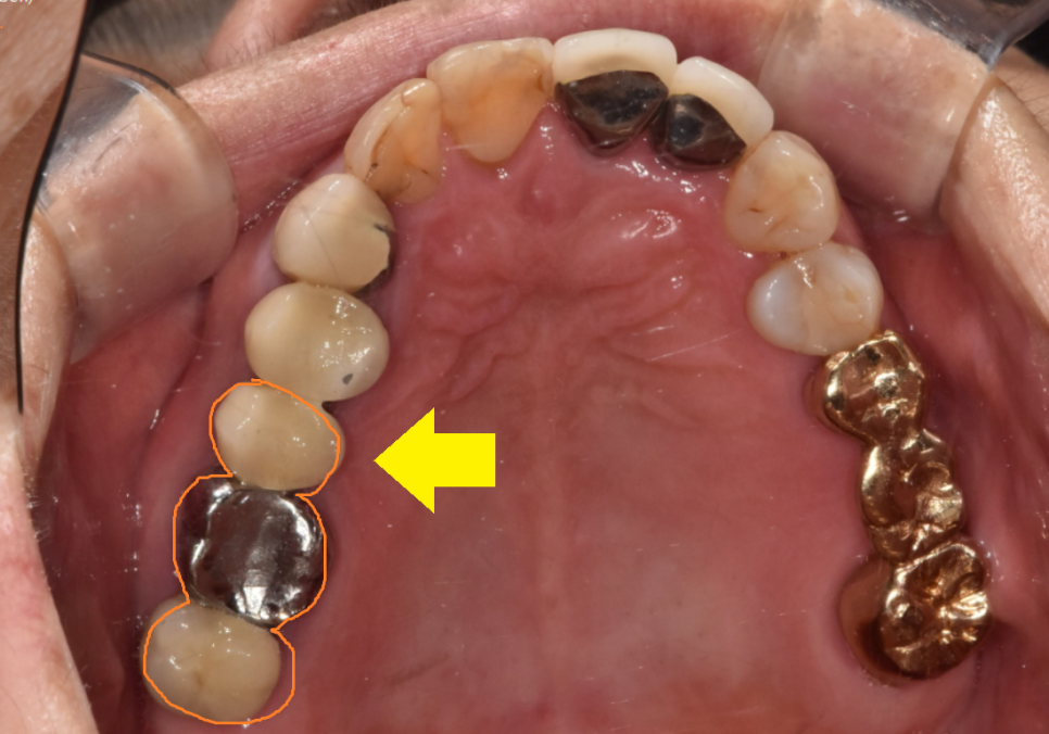풍산동 치과 임플란트 시술후 통증 부작용은 아닐까? 관련 이미지 2