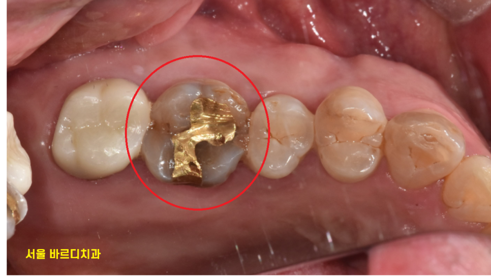 고덕동 치과 검진 시 이게 빠지면 말짱 도루묵!!! 관련 이미지 4