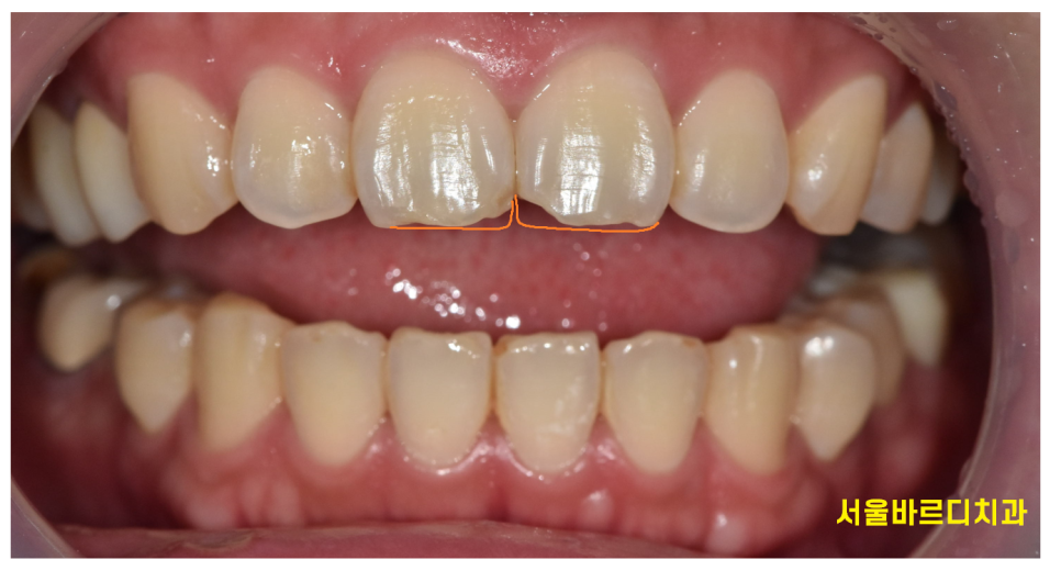 살짝 깨진 앞니 레진과 라미네이트 갈림길 어떤게 더 좋을까? 관련 이미지 2