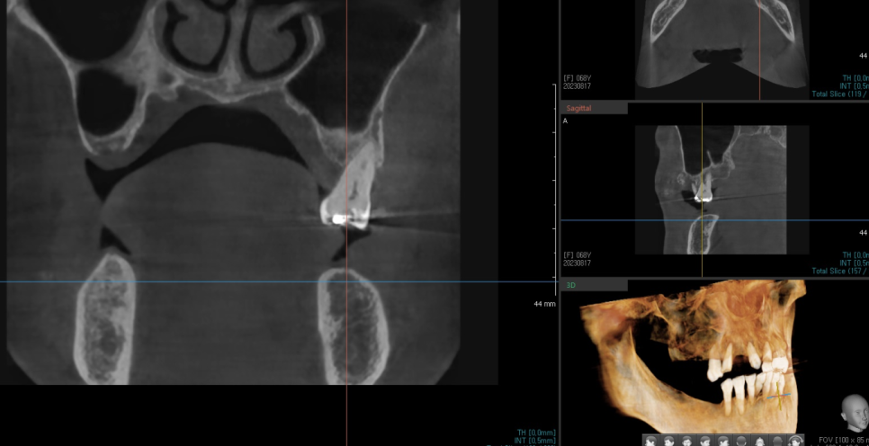 전체적인 치아 치료 13개의 임플란트를 식립한 환자분 관련 이미지 7