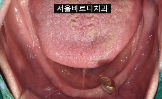 임플란트 틀니 치아가 없을 때 하남미사치과에서 해결하세요. 관련 이미지 5