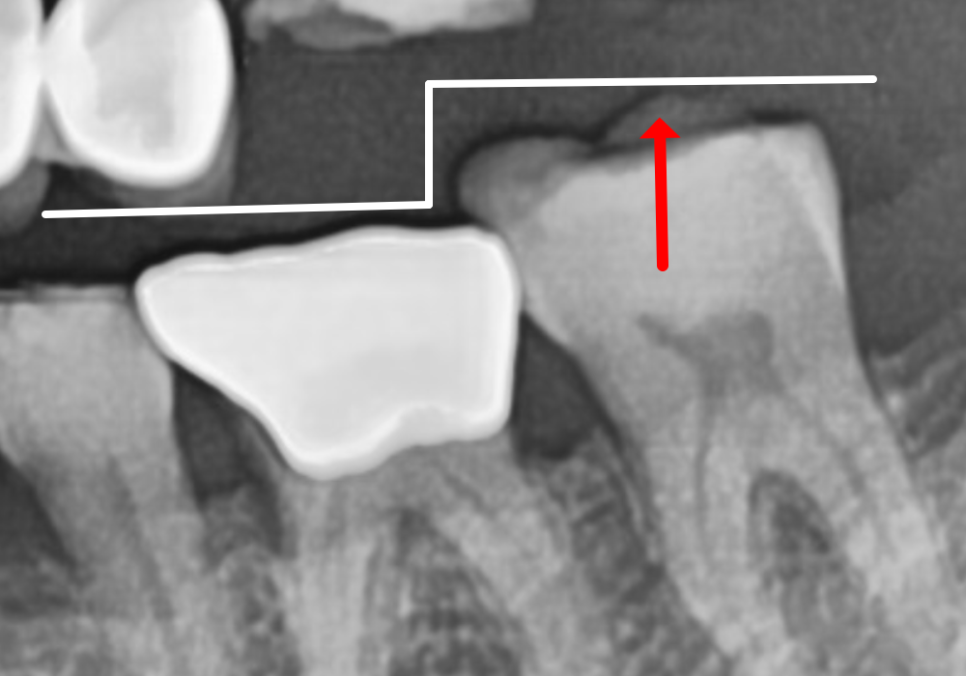 앞니 길어짐, 위 앞니가 점점 내려온다면? 관련 이미지 1