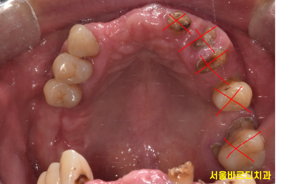 상일동 임플란트 잘하는곳 치료는 이렇게 진행됩니다. 관련 이미지 3
