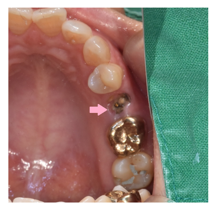 씌운 치아 부러짐 뿌리만 남은 경우 임플란트로 수복하기 관련 이미지 1