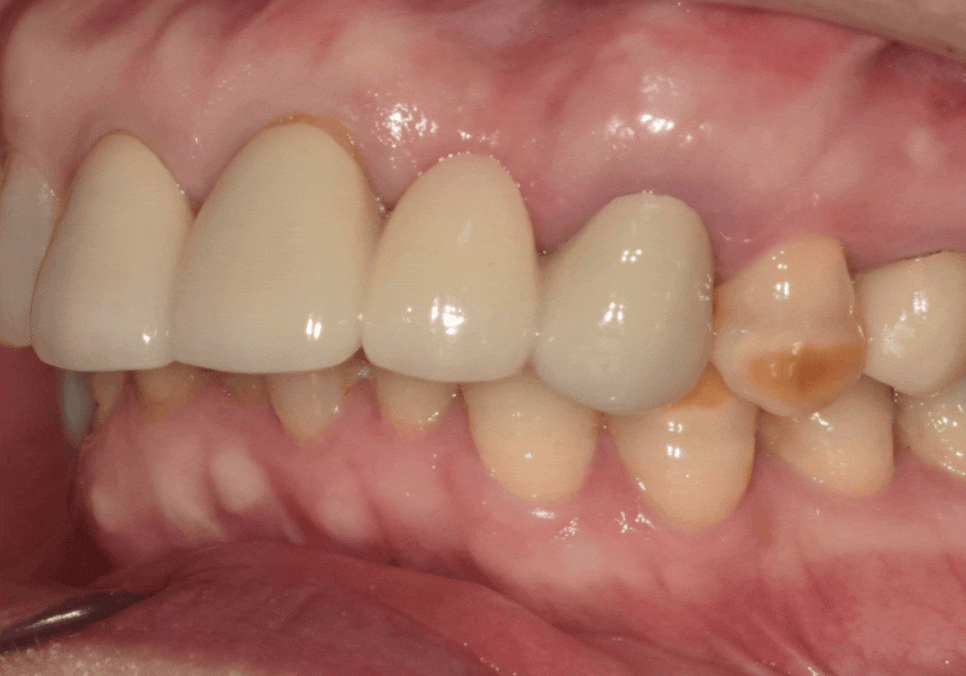 오래된 앞니 크라운 냄새, 관련 이미지 4