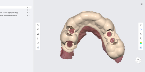 네비게이션 임플란트가 왜 좋다고 그러는거죠? (feat.13가지 장점) 관련 이미지 3