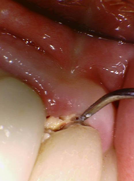 음식물 끼임, 거뭇한 무언가 보인다면? 이미 늦었을 수 있습니다. 관련 이미지 4