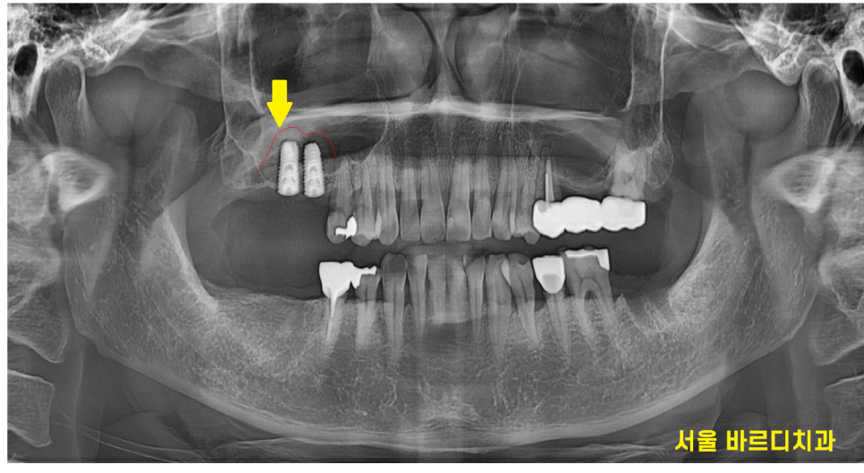 미사 임플란트 상악동 거상술 제일 어렵고 난이도가 높습니다. 관련 이미지 4