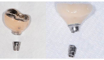 강동구 치과 임플란트 흔들림 나사 풀림 머리가 돌아가요!!! 대처법은? 관련 이미지 5