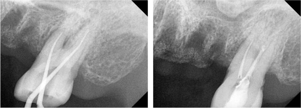 고덕동치과 서울바르디치과 무절개 네비게이션 임플란트 치료증례 #2 관련 이미지 13